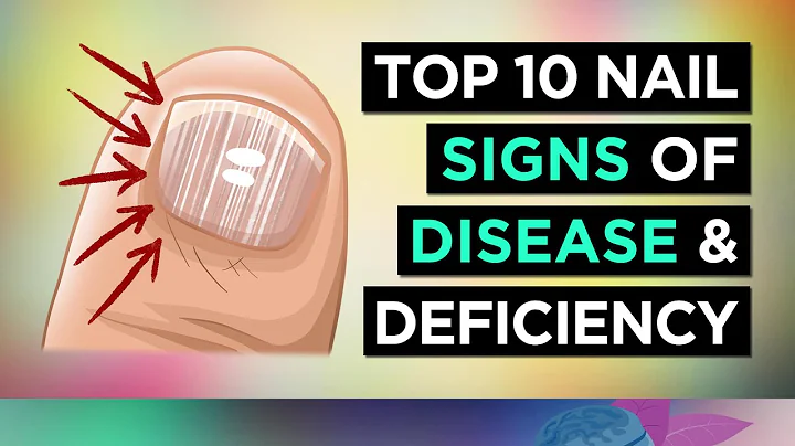 10 tecken på hälsoproblem som visas på dina naglar