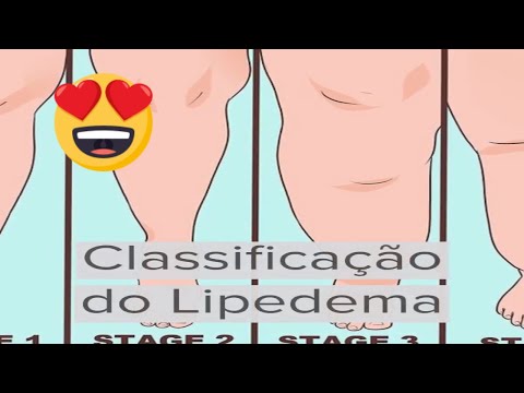 Classificação do Lipedema