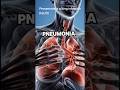 What Is Pneumonia? Symptoms You Must Know #pneumonia #pneumoniaawareness