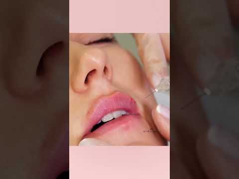 حقن حمض الهيالورونيك يدعم الهلام الموجود في الحشو شكل الشفتين ويكبرها لعملية تحديد الشفايف بالفيلر
