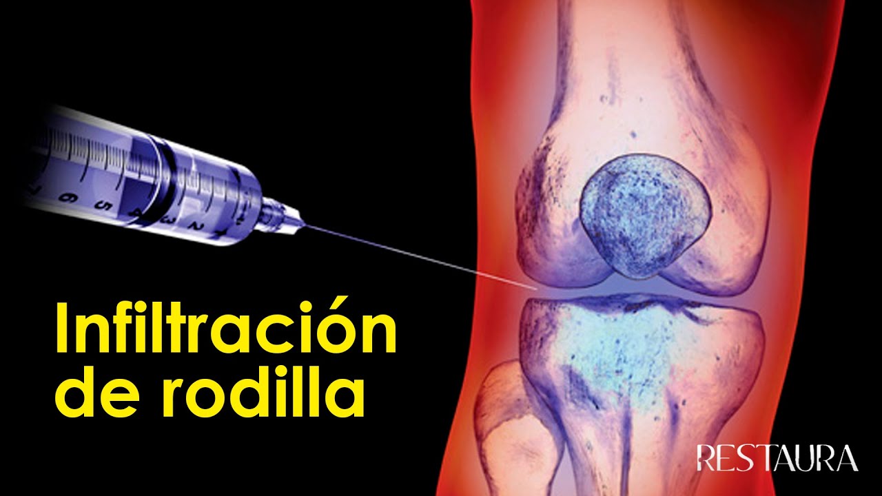 Infiltración de rodilla Todo lo que necesitas saber YouTube