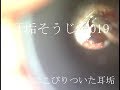 耳垢そうじ/外耳道にこびりついた耳垢/019