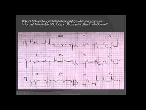 ეკგ / 50 წლის ბიზნესმენი მიოკარდიუმის წინაგვერდითი კედლის მწვავე ინფარქტითა და ექსტრასისტოლიით