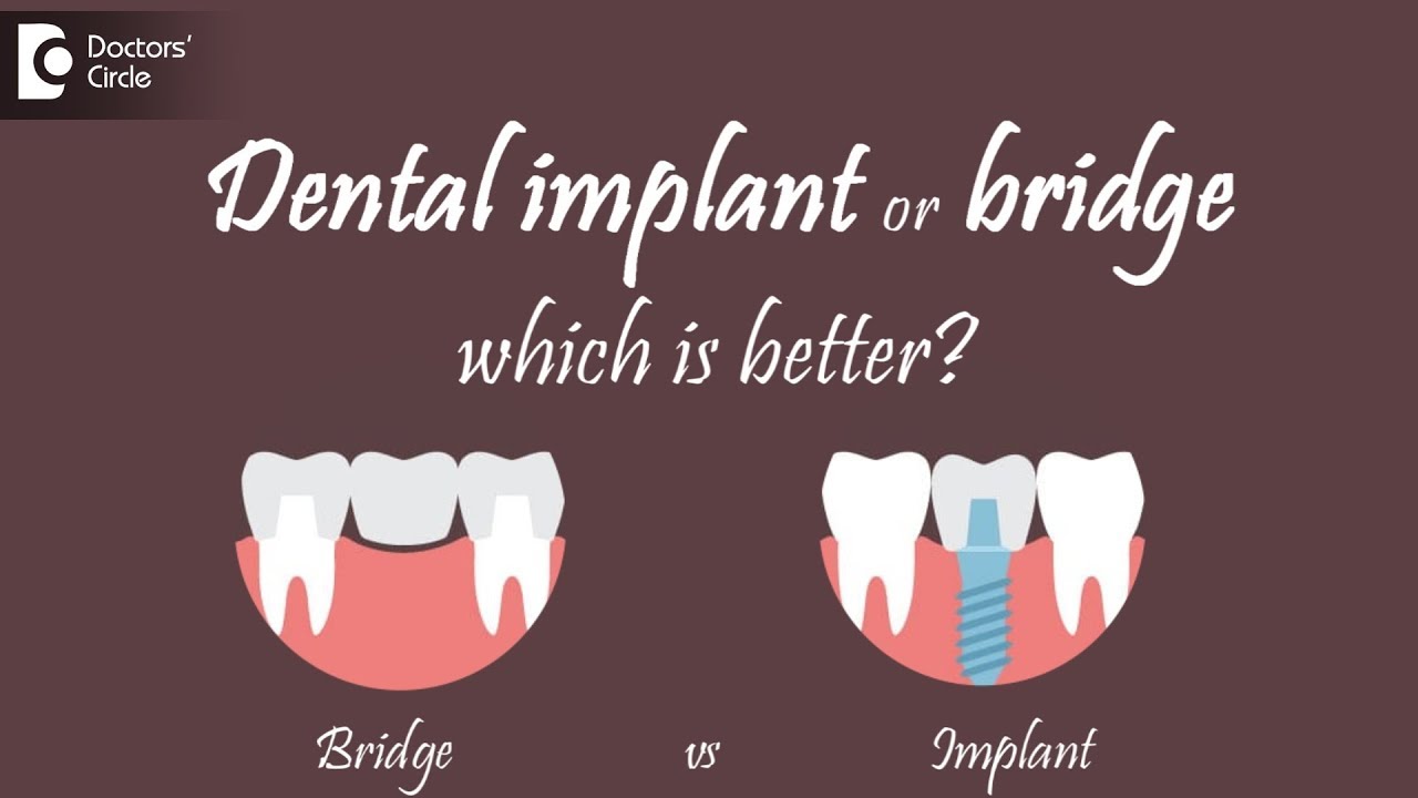 Dental Implant Or Bridge Which Is Better?