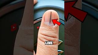 Black Line On Your Nail Can Be Dangerous