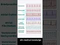 Normal ECG vs Heart attack ECG #trending #nurse #dactor #shortsfeed #shorts #viralshort #medicine
