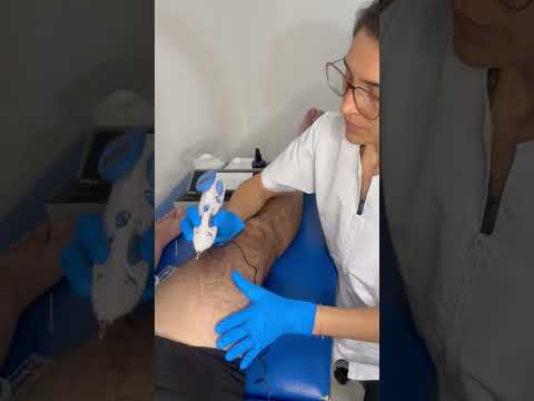 Aquí te dejamos los 5 usos principales de la neuromodulación percutánea