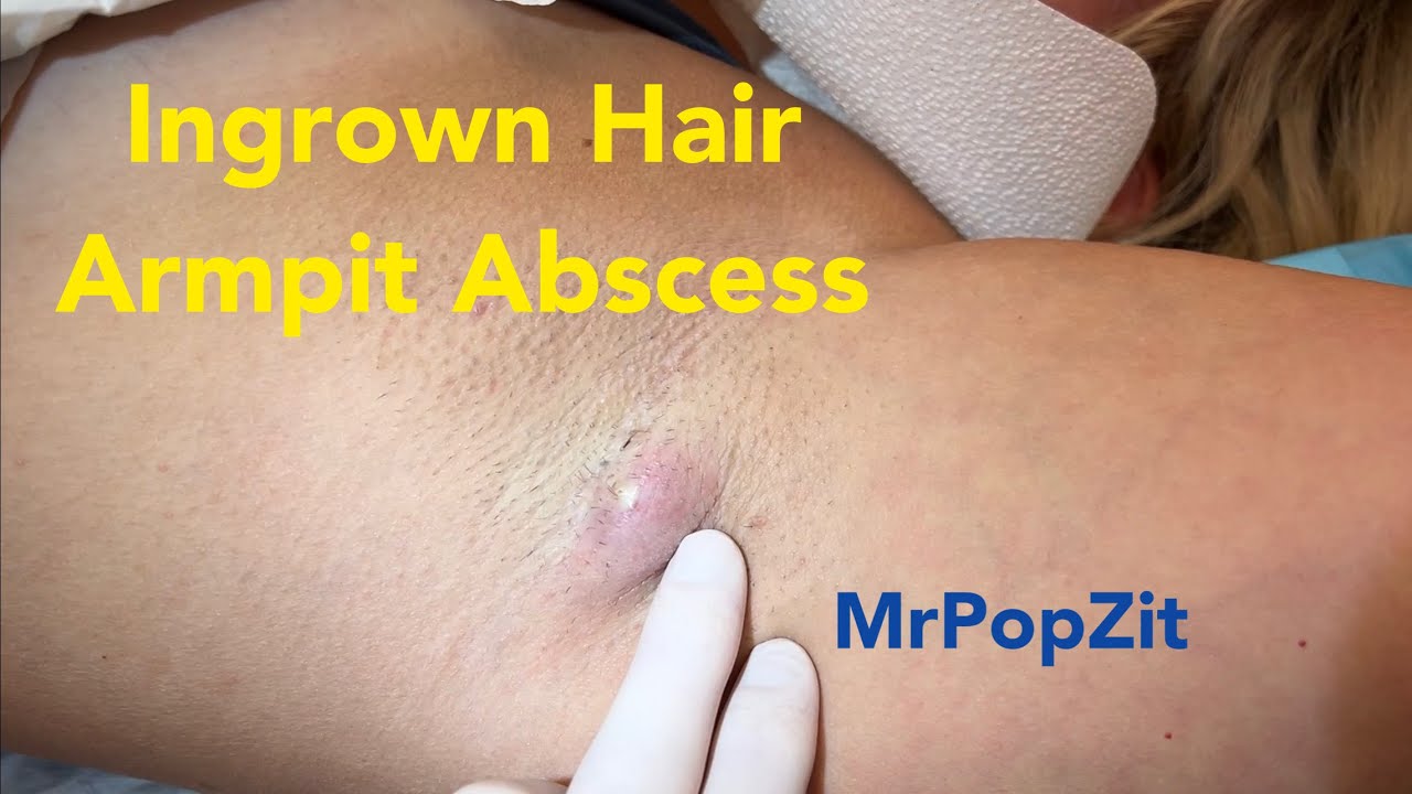 Ingrown hair armpit abscess Surprising amount of hair and discharge  expressed Incision  drainage  YouTube