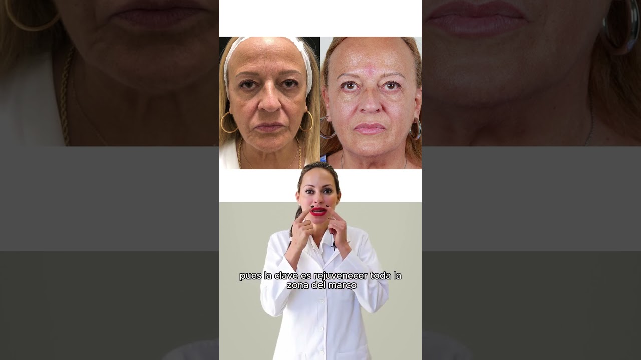 Adela rejuvenece la zona perioral con medicina estética ✨