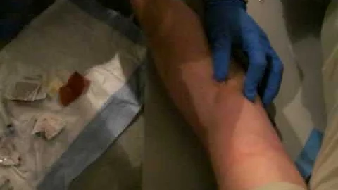 Z being stuck for a IV