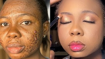 HOW TO COVER ACNE DARK SPOTS /MARKS & HYPERPIGMENTATION | FOUNDATION ROUTINE for hyperpigmentation