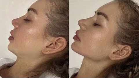 Extreme 𝓙awline and 𝓒hin reconstruction ₊˚🖇️ ✩ [1X MAX]