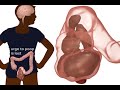 The Poo in You - Constipation and Encopresis Educational Video