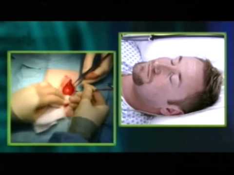 Video: Operation Under Hypnose - Alternativ Visning