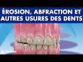 Érosion dentaire, abfraction, attrition et autres USURES DES DENTS ©