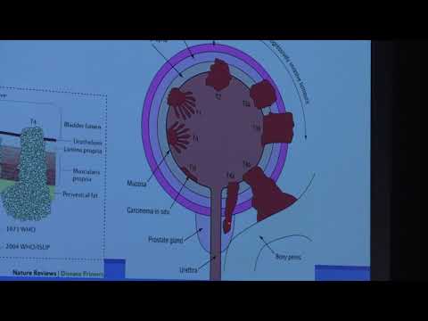 Video: Trombectomie - Soorten Operaties, Indicaties, Resultaten