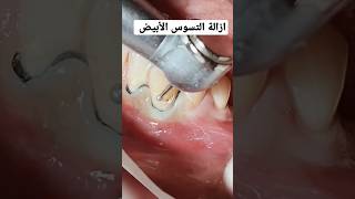 composite class V ||White tooth decay||白い虫歯||सफेद दांतों का सड़ना #dentist #dentista #dental #fyp