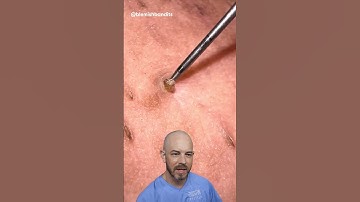 Satisfying impacted hair removal from the armpit!(credit: @blemishbandits on TT) #doctor #satisfying