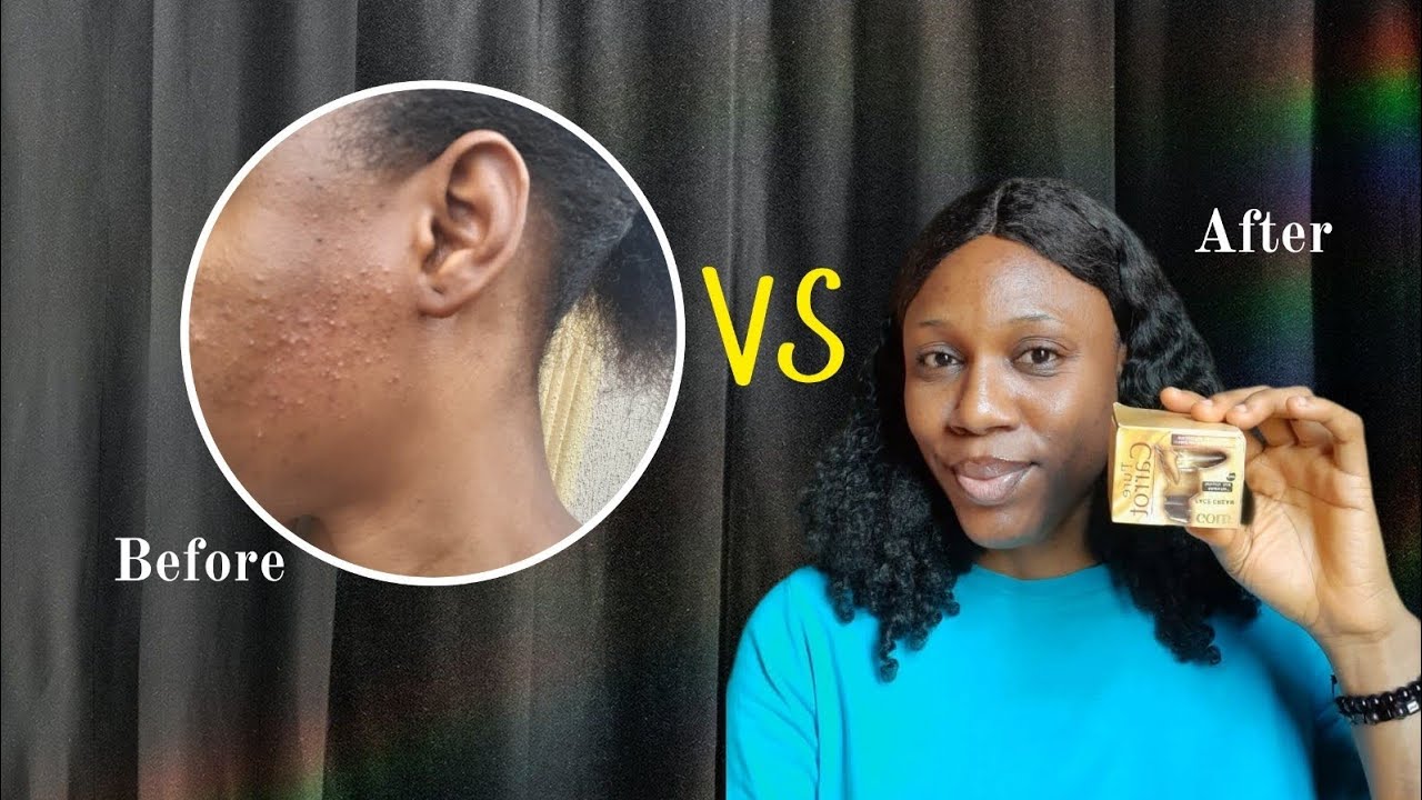 Pure Carrot Face Cream | How I Cleared Acne Scars, Dark Spots and Marks