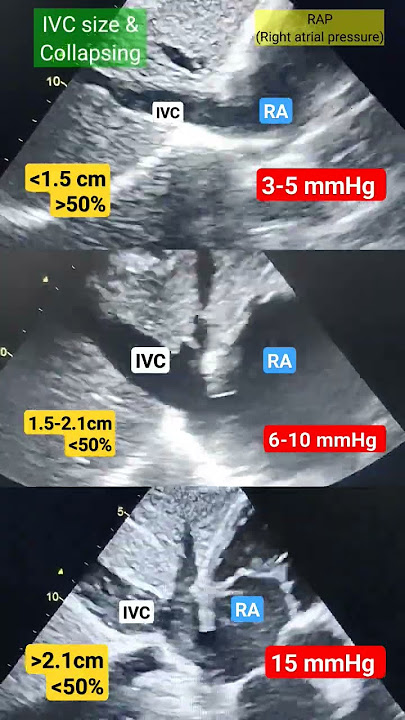 Right atrial pressure by IVC size l Subcostal IVC view # echo # shorts