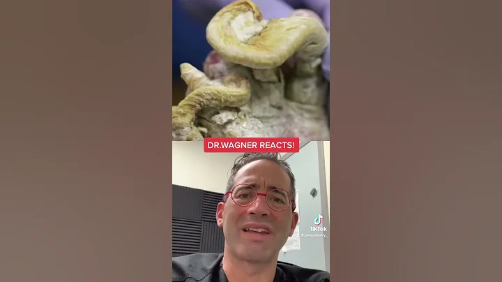 BIGGEST THICKEST TOENAILS? 😢 #shorts #toenail #fungus