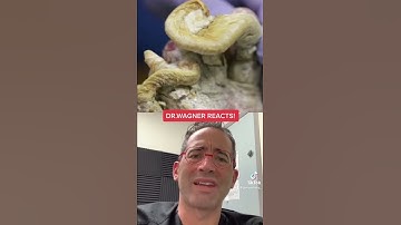 BIGGEST THICKEST TOENAILS? 😢 #shorts #toenail #fungus