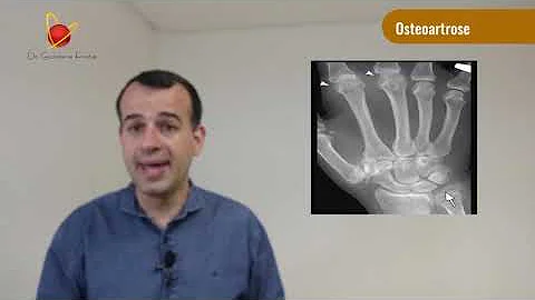 Como acontece a osteoartrose?