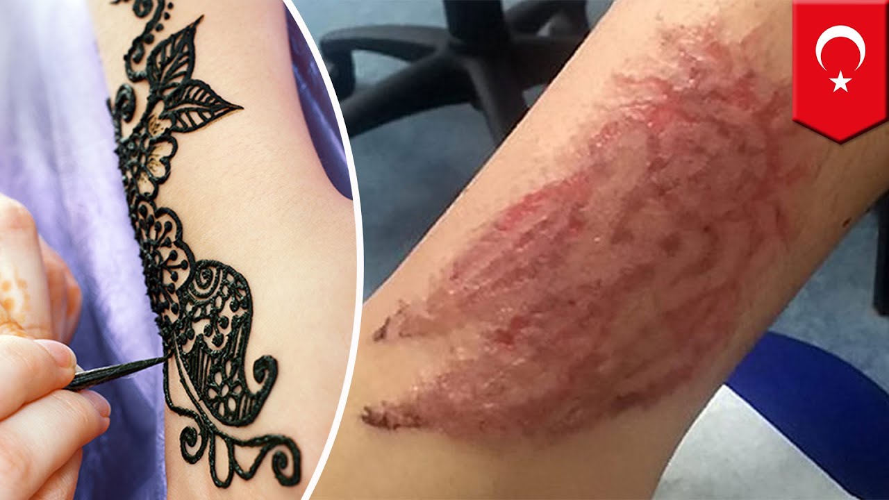 Tato Henna Hitam Beracun Bakar Kulit Tinggalkan Luka TomoNews