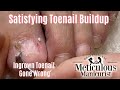 👣 Satisfying Excess Toenail Buildup Removal Black Friday Specials👣