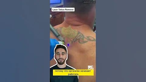 удаление тату