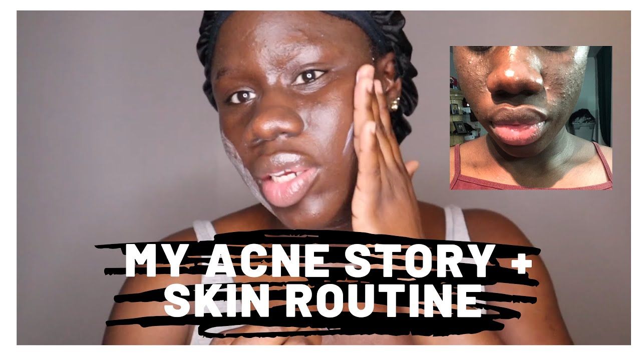How I Cleared Up My Break Out (Acne) + Skin Routine - YouTube