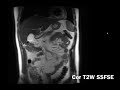 Introduction to Abdominal MRI: Background, Pulse Sequences, Normal Appearance (Body MRI, Abdo MRI)