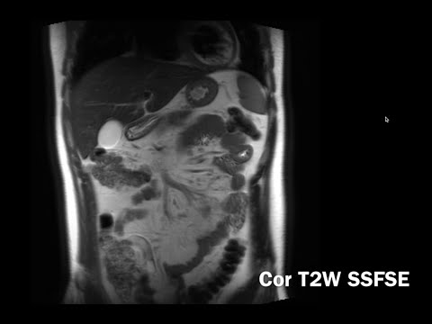 Video: Kas ir gradienta MRI?