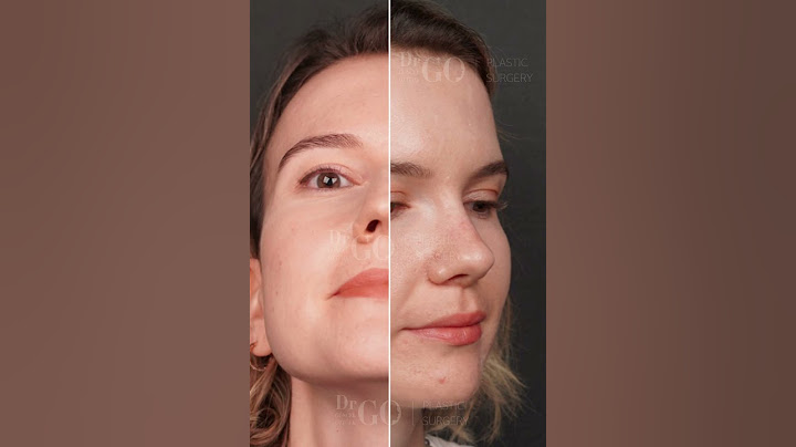 After five months, we are thrilled to share the outstanding results for our cherished patient  ✨