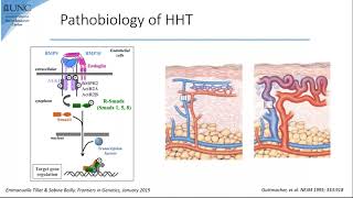 Webinar: Hereditary Hemorrhagic Telangiectasia in 2021: Diagnosis and Advances in Treatment screenshot 4