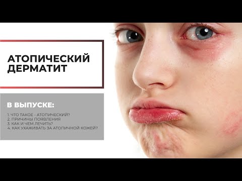 Атопический дерматит. Как