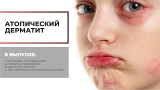 Атопический дерматит. Как лечить и можно ли вылечить?