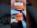 تركيبة متحركه مرنه وثابته Felix Denture Dr Abdullah Sultan Dentist Dentist 