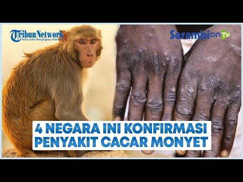 Penyakit Cacar Monyet Meluas, 4 Negara Ini Melaporkannya