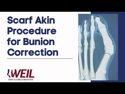 Scarf Akin Procedure for Bunion Correction | Weil ...