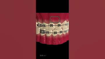 How Does Dental Braces Work