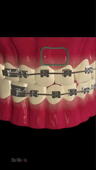 How Does Dental Braces Work