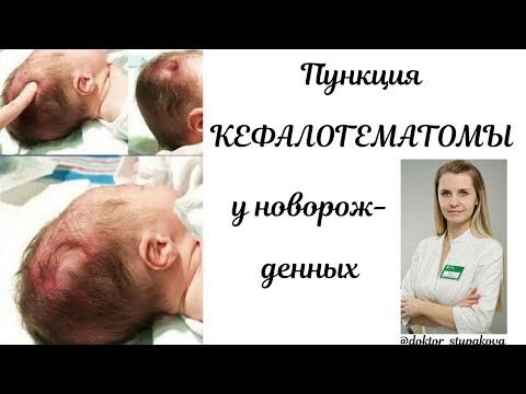 Видео: Кефалогематома при новородено на главата: причини и лечение