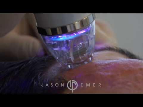 Acne Scars Treatment EndyMed Intensif RF Radio Frequency with Bellafill injections