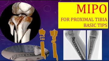MIPO for Proximal Tibia Fractures: Stepwise Basics