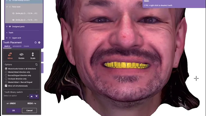 Digital denture workflows explained