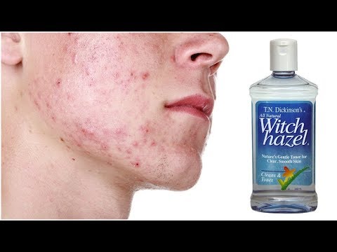 Come utilizzare amamelide per acne