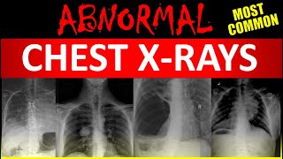 Interpretacao anormal de radiografia de torax radiologia medico estudantedemedic