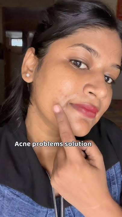 Acne problem solution at home😱 - YouTube