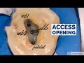 Maxillary Molar Access Opening (MB2)